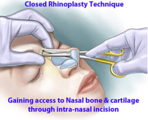 Close-Rhinoplasty-Procedure