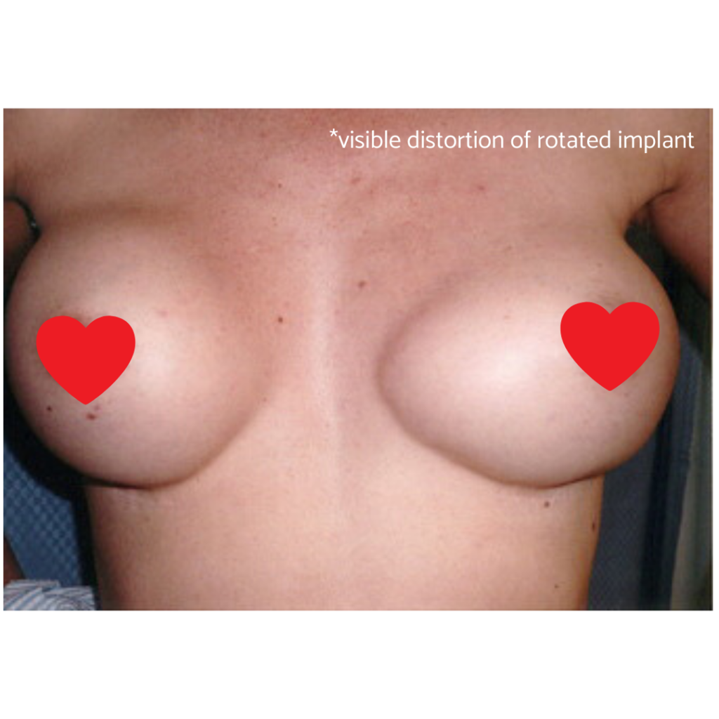 how to achieve a natural breast augmentation