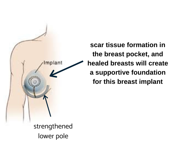 breast implant pocket, breast implants brisbane