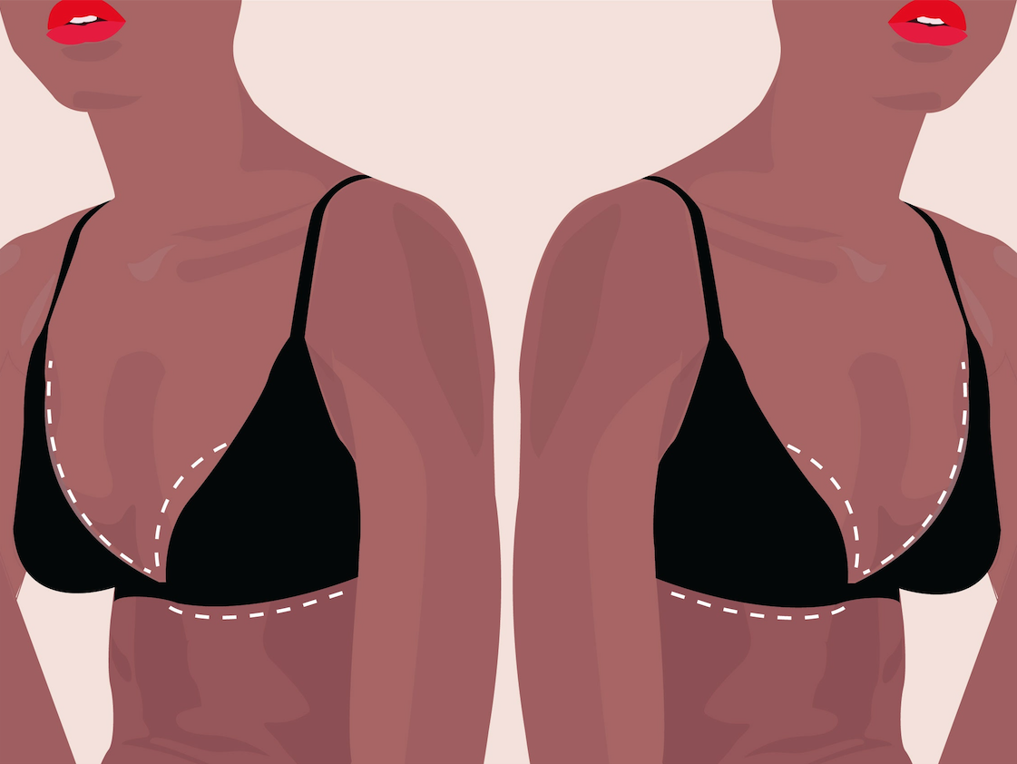 Breast Lift and Implants in Two Stages: Pros and Cons