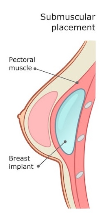 under the muscle breast implant placement