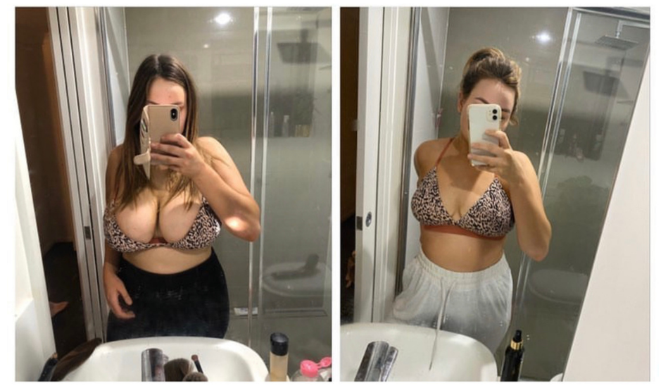 Recovery after Breast Reduction - Brisbane Plastic & Cosmetic Surgery