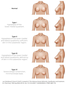 tuberous breast correction surgery