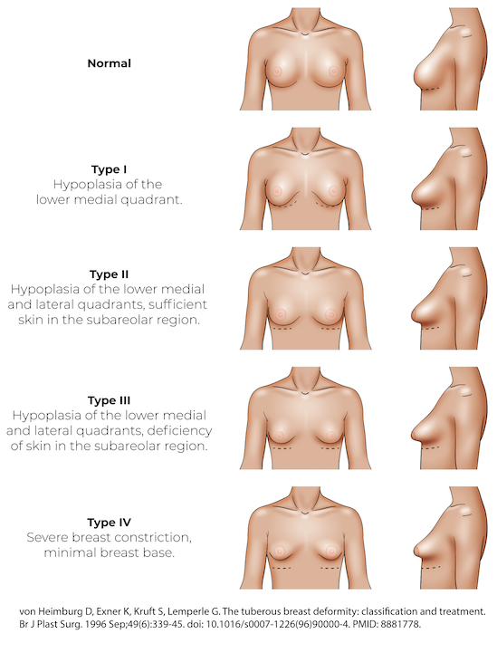 Tuberous Breast Diagnosis and Treatment - Imagine Plastic Surgery