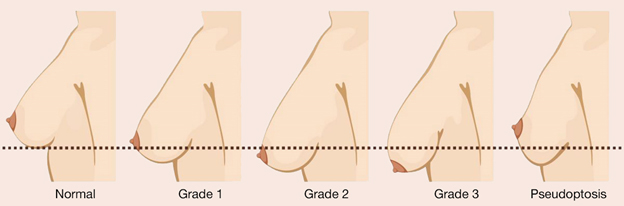 Understanding Breast Lift & Implants - Brisbane Plastic Surgery