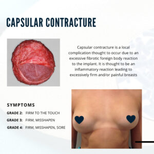 capsular contracture