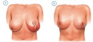 breast reduction brisbane