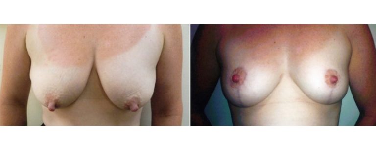 Patient's age 36, breast lift before and after, front view, Dr Richardson Brisbane