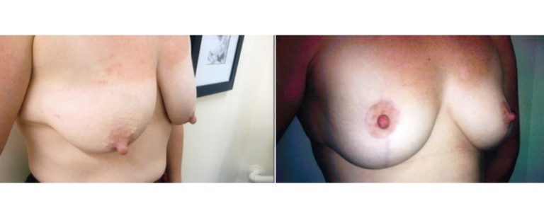 Patient's age 36, breast lift before and after, angle view, Dr Richardson Brisbane