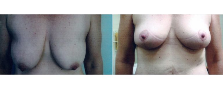 Bilateral breast lift, surgery results, patient's age 45, front view, BPCS, Brisbane, QLD