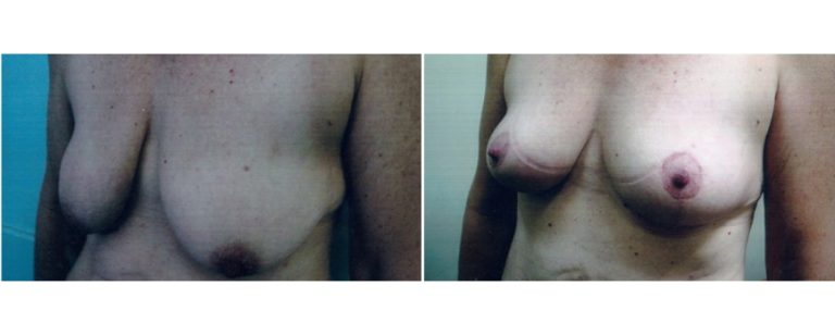 Bilateral breast lift, surgery results, patient's age 45, angle view, BPCS, Brisbane, QLD