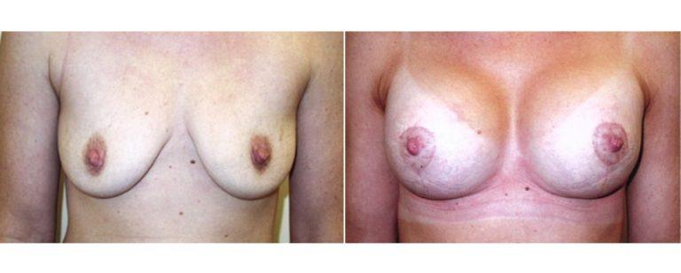 Breast lift and implants, patient's age 33, before and after, front view, Dr Richardson Brisbane