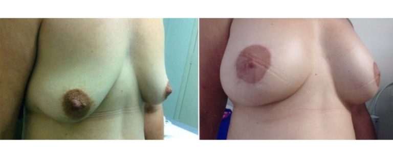 Breast Lift with Implants, patient's age 39, before and after, angle view