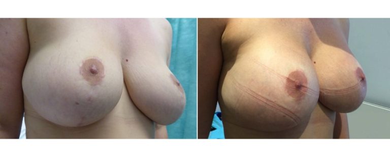 Breast lift with implants, before and after 10, angle view, Dr Richardson, Brisbane, QLD