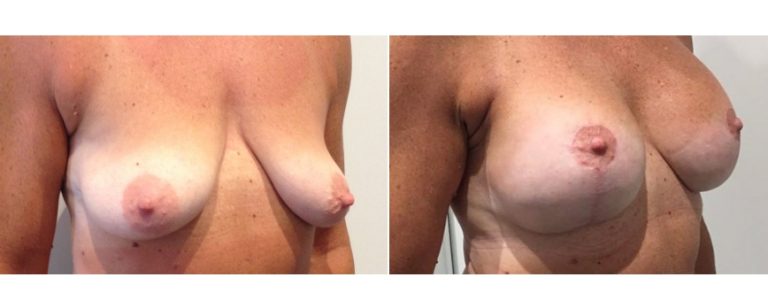Breast lift with implants, before and after 11, angle view, Dr Richardson, Brisbane, QLD