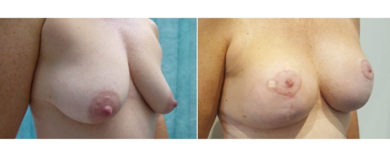 Patient, age 43, breast lift with implants, before and after 12, angle view, Dr Richardson, Brisbane, QLD
