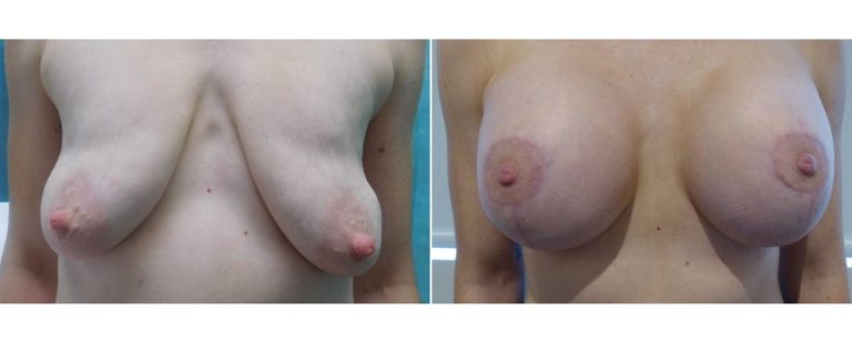 Breast lift and augmentation with implants, before and after 14, front view, Dr Richardson, Brisbane, QLD