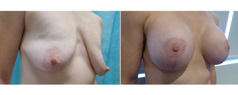 Breast lift and augmentation with implants, before and after 14, angle view, Dr Richardson, Brisbane, QLD