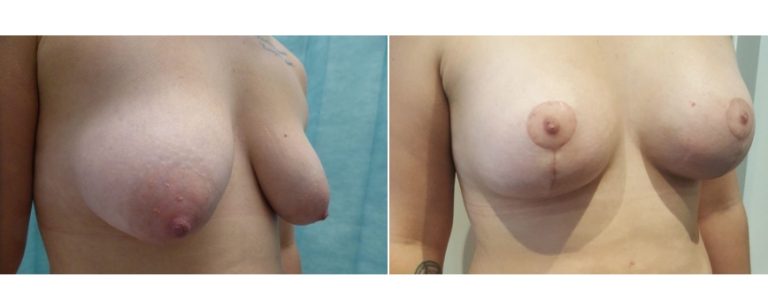 Breast lift with implants, before and after 15, side view, Dr Richardson Brisbane