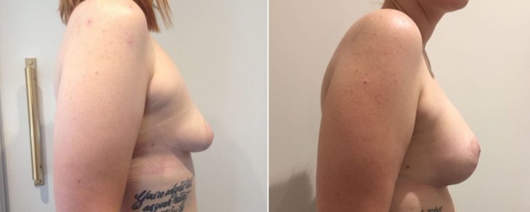 Breast lift with implants, before and after 16, side view, Dr Richardson Brisbane