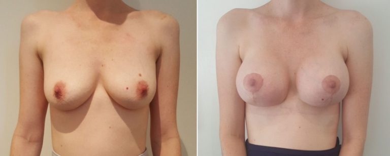 Breast lift with implants, before and after 17, Brisbane Plastic Surgery, front view, Dr Richardson