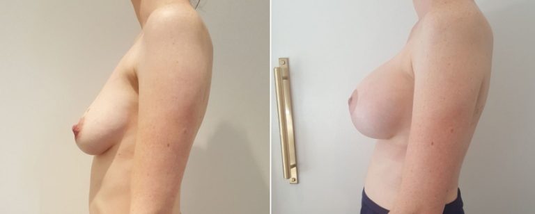 Breast lift with implants, before and after 17, Brisbane Plastic Surgery, side view, Dr Richardson