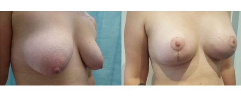 Breast lift with implants, before and after 18, Brisbane Plastic Surgery, angle view, Dr Richardson