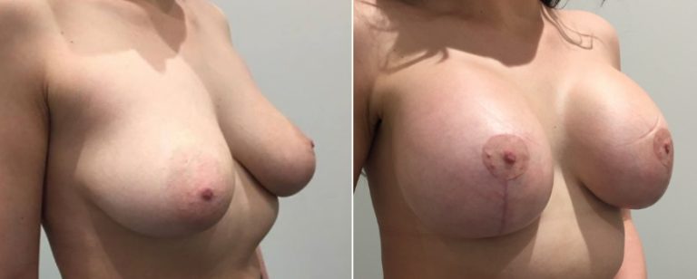 Breast lift with implants, before and after 19, Brisbane Plastic Surgery, angle view, Dr Richardson