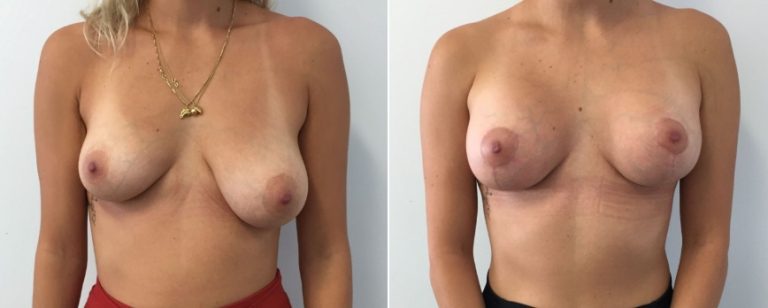 Breast lift with implants (combined surgery), before and after 20, Brisbane Plastic Surgery, front view