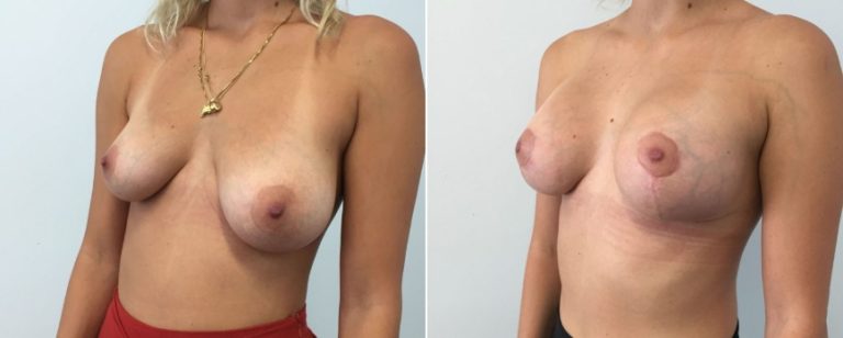 Breast lift with implants, before and after 20, Brisbane Plastic Surgery, angle view