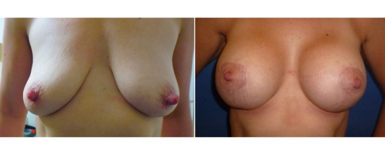 Augmentation mastopexy surgery, before and after 4, front, BPCS Brisbane