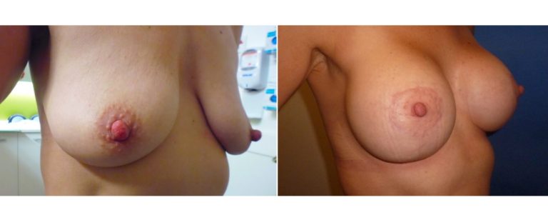 Augmentation mastopexy surgery, before and after 4, angle, BPCS Brisbane