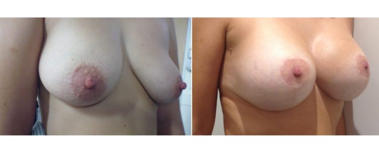 Breast lift with implants, before and after 7, angle view, Dr Richardson, Brisbane, QLD