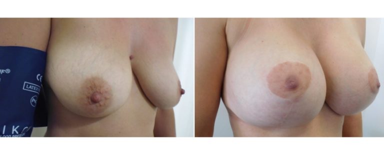 Breast lift with implants, before and after 8, angle view, Dr Richardson, Brisbane, QLD