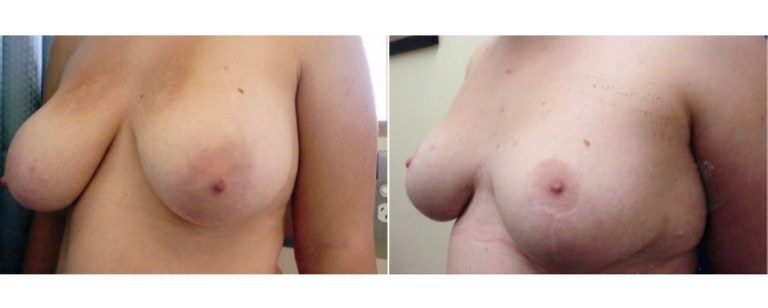 Breast reduction surgery (age 17), before and after, angle view, Dr Richardson Brisbane