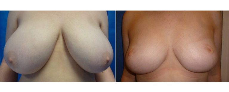 BPCS patient before and after breast reduction surgery (age 19), front view, Brisbane Plastic Surgery