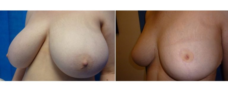 BPCS patient before and after breast reduction surgery (age 19), angle view, Brisbane Plastic Surgery
