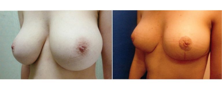 Reduction mammoplasty (age 19), before and after, angle view, Dr Richardson Brisbane