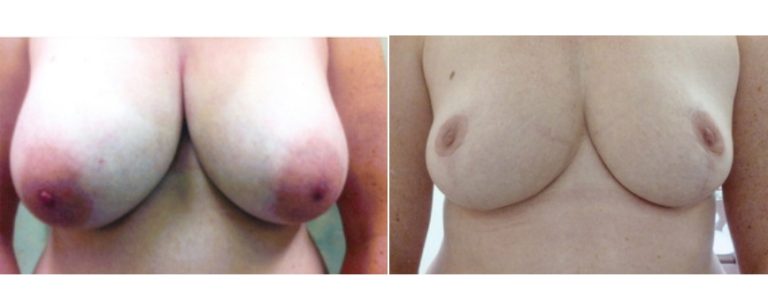 Reduction mammoplasty (age 43), before and after, front view, Dr Richardson Brisbane