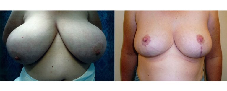 Reduction mammoplasty (age 45), before and after, front view, Dr Richardson Brisbane