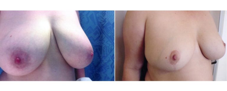 Breast reduction surgery (age 46), before and after, angle view, Dr Richardson Brisbane