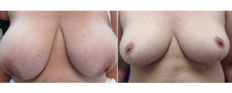 BPCS patient before and after breast reduction surgery (age 47), front view, Brisbane Plastic Surgery