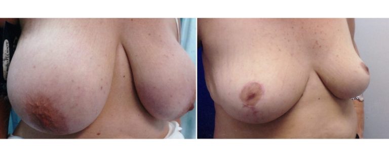 BPCS patient before and after breast reduction surgery (age 47), angle view, Brisbane Plastic Surgery