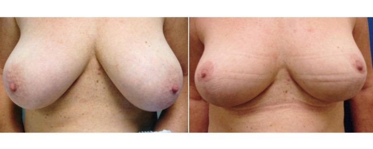 Breast reduction surgery (age 50), before and after, angle view, Dr Richardson Brisbane