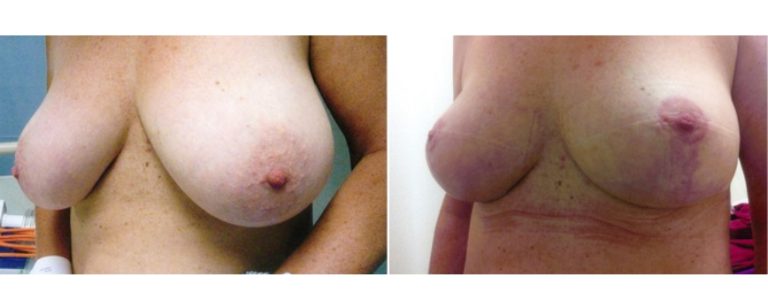 Breast reduction surgery (age 50), before and after, angle view, Dr Richardson Brisbane