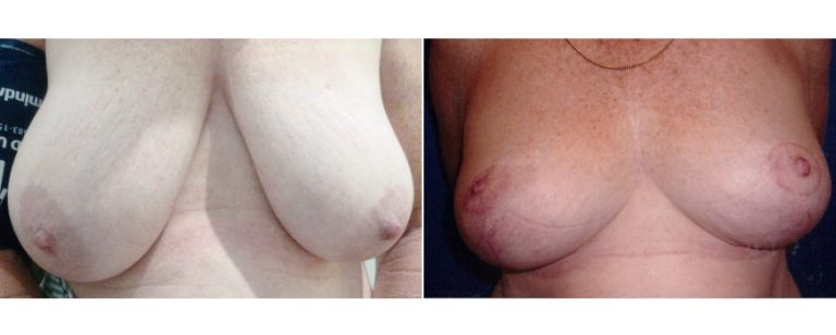 BPCS patient before and after breast reduction surgery (age 52), front view, Brisbane Plastic Surgery