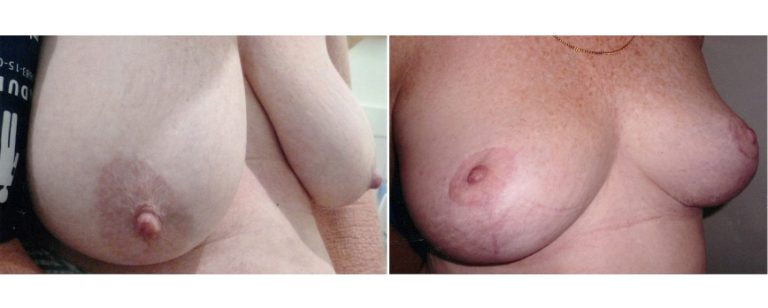 BPCS patient before and after breast reduction surgery (age 52), angle view, Brisbane Plastic Surgery