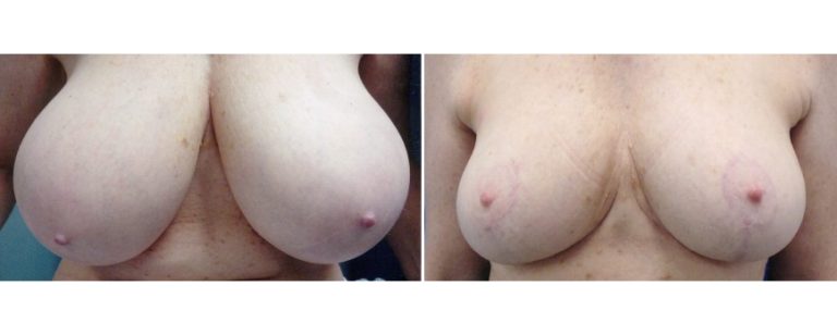 BPCS patient before and after breast reduction surgery (age 59), front view, Brisbane Plastic Surgery