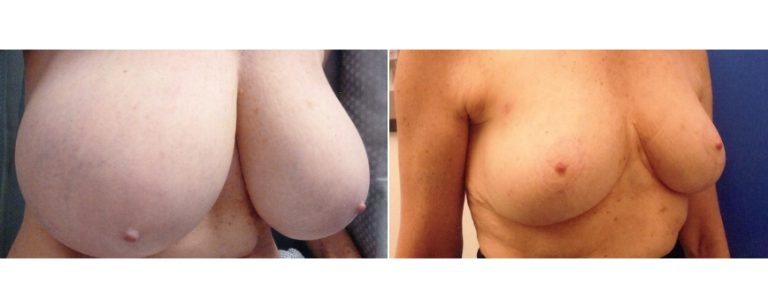 BPCS patient before and after breast reduction surgery (age 59), angle view, Brisbane Plastic Surgery