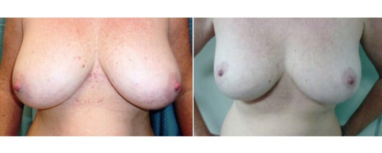 Reduction mammoplasty (patient's height 162 cm), before and after, front view, Dr Richardson Brisbane